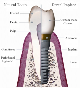 dental implant model