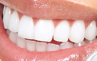 Get a Picture Perfect Smile with Teeth Whitening