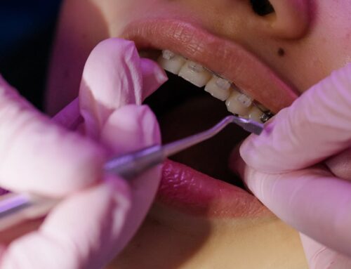 Choosing Between Braces and Veneers for a Straighter Smile