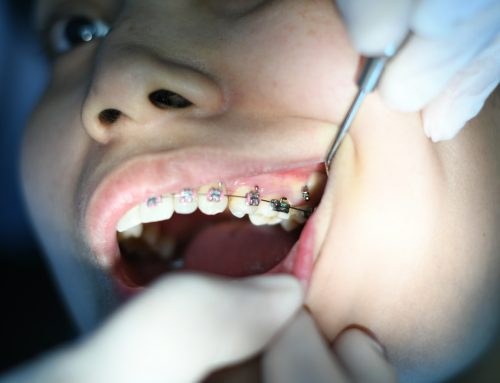 Summer Orthodontic Checkups for Flower Mound Teens