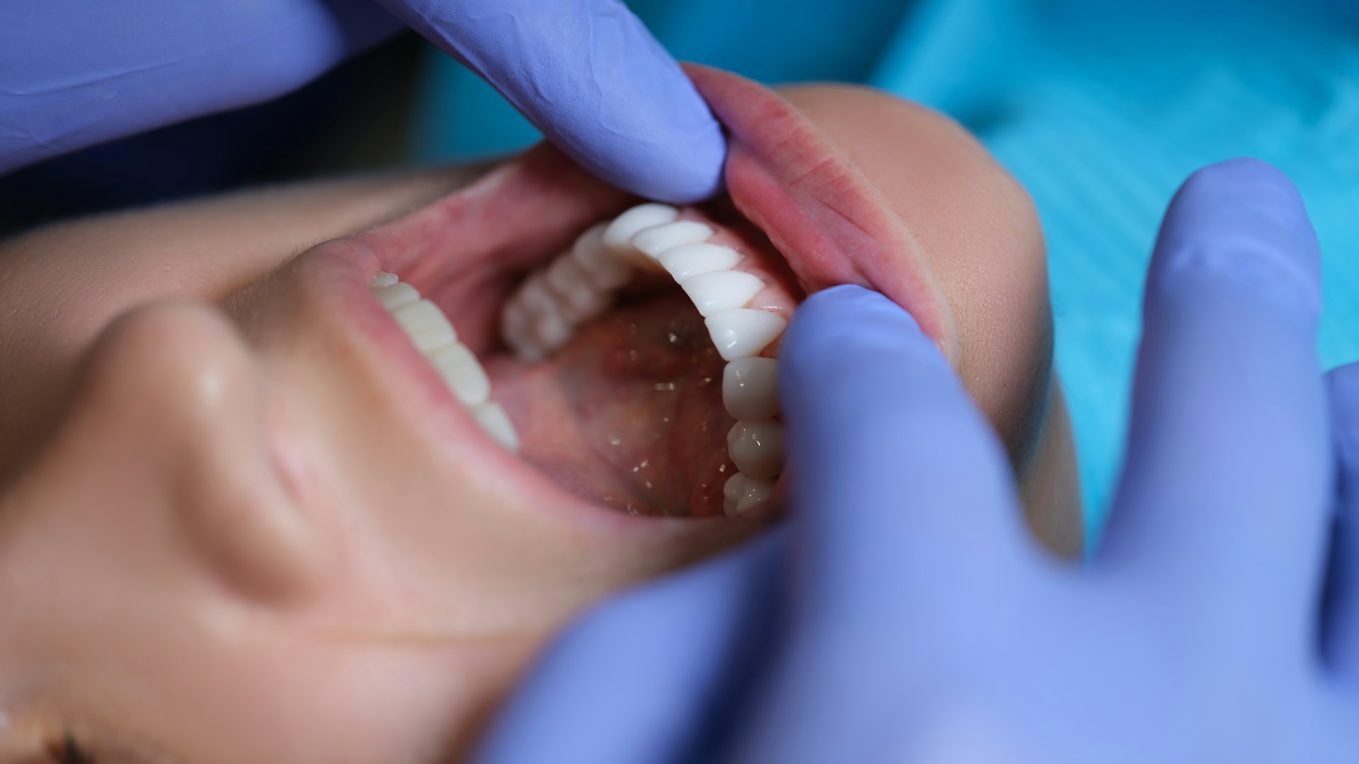 Gum Disease